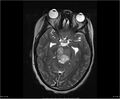 Brainstem glioma (Radiopaedia 21819-21775 Axial T2 15).jpg
