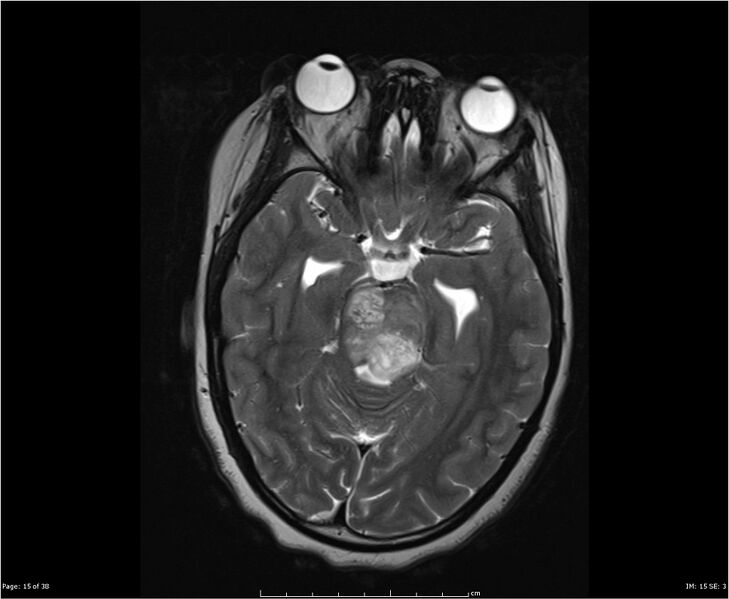 File:Brainstem glioma (Radiopaedia 21819-21775 Axial T2 15).jpg