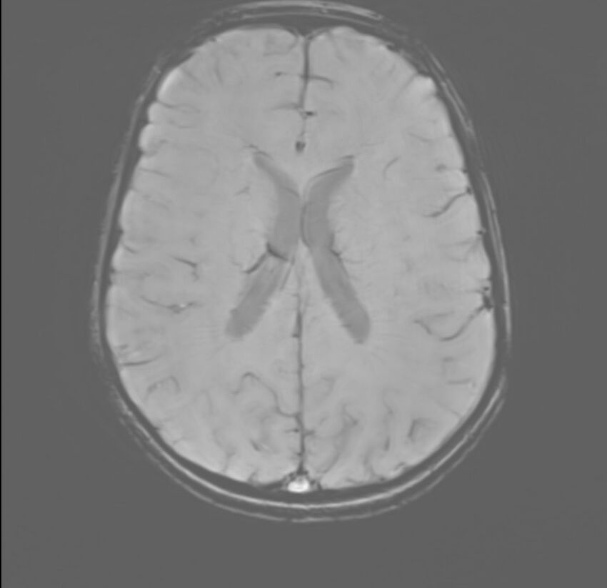 Brainstem glioma (Radiopaedia 70548-80674 Axial SWI 39).jpg