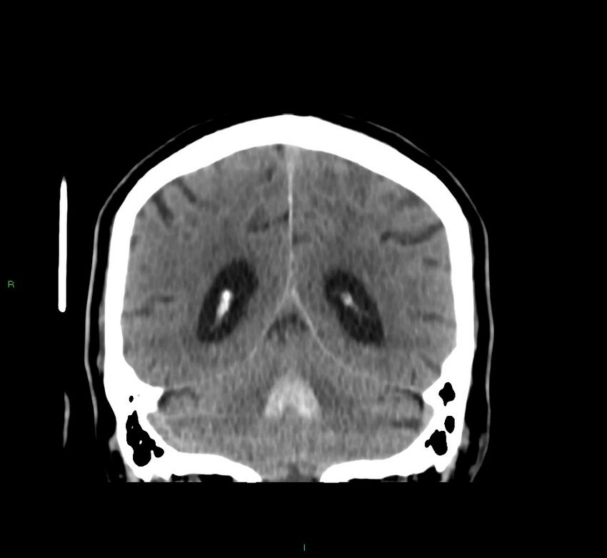 Brainstem hemorrhage (Radiopaedia 58794-66028 Coronal non-contrast 23).jpg