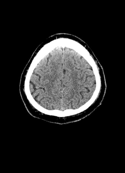 File:Brainstem hemorrhage (Radiopaedia 81294-94976 Axial non-contrast 15).jpg