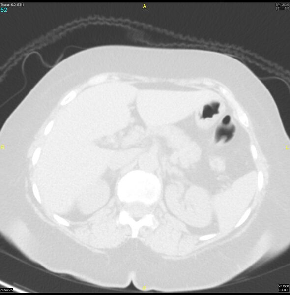 File:Breast primary with lung and bone metastases (Radiopaedia 40620-43228 Axial lung window 52).jpg