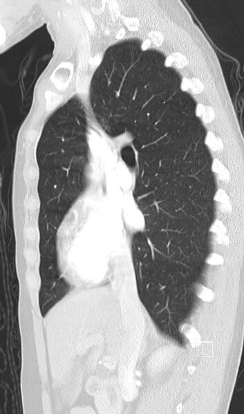 File:Bronchial atresia (Radiopaedia 73677-84470 Sagittal lung window 23).jpg