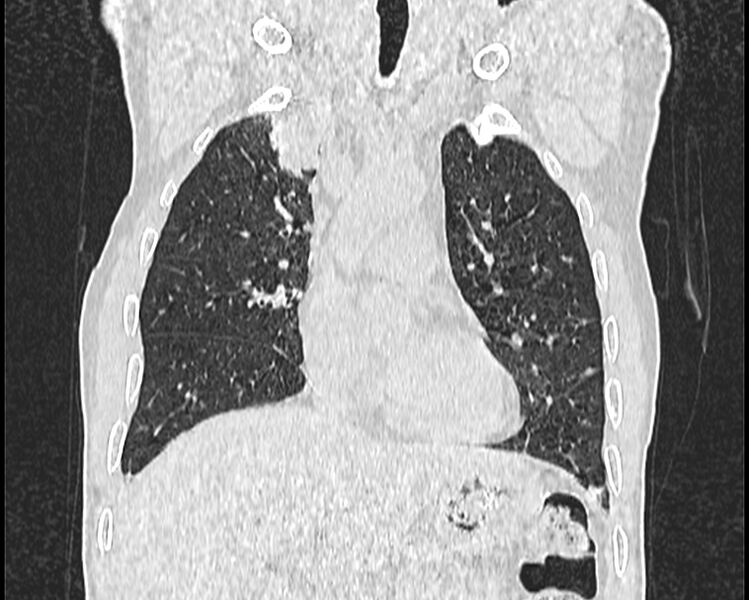 File:Bronchogenic carcinoma with superior vena cava syndrome (Radiopaedia 36497-38054 Coronal lung window 11).jpg
