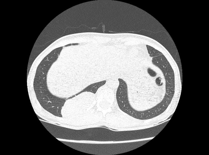 Bronchogenic cyst (Radiopaedia 80273-93615 Axial lung window 31).jpg