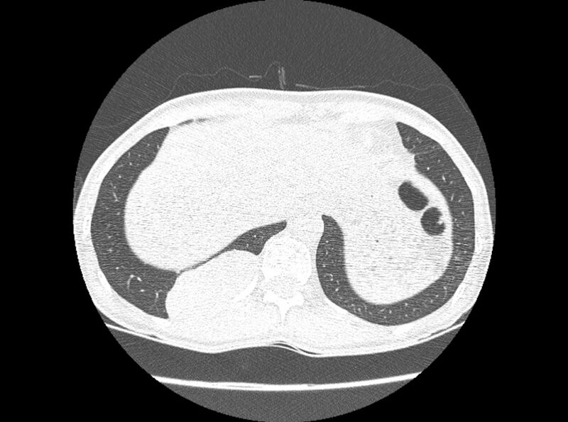 File:Bronchogenic cyst (Radiopaedia 80273-93615 Axial lung window 32).jpg