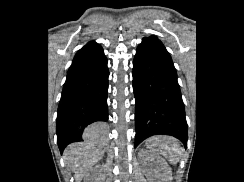 Bronchogenic cyst (Radiopaedia 80273-93615 D 113).jpg