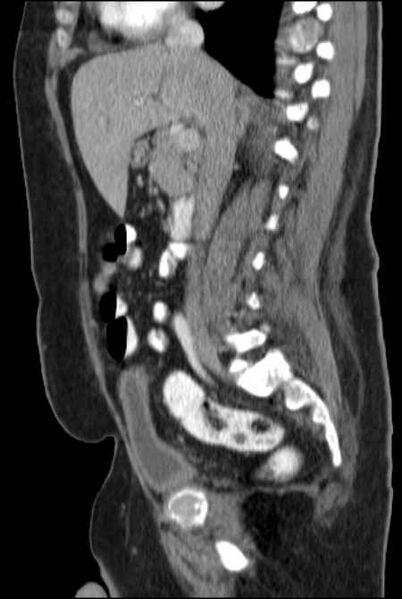 File:Brown tumors compressing the spinal cord (Radiopaedia 68442-77988 F 25).jpg