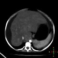 Budd-Chiari syndrome (Radiopaedia 23072-23103 C+ arterial phase 5).jpg