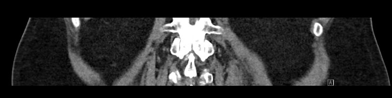 File:Buried bumper syndrome - gastrostomy tube (Radiopaedia 63843-72575 Coronal Inject 81).jpg