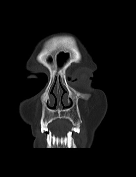 File:Burnt-out meningioma (Radiopaedia 51557-57337 Coronal bone window 2).jpg