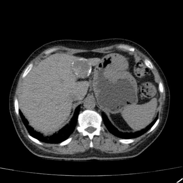 File:Calcified hepatic hydatid cyst (Radiopaedia 26872-27046 Axial non-contrast 19).jpg