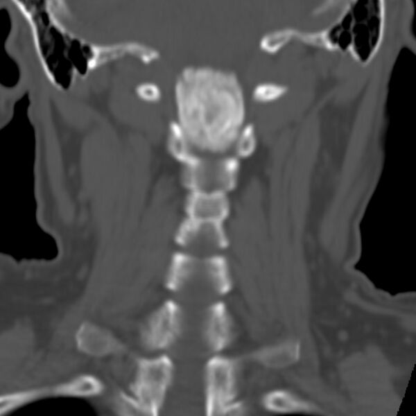 File:Calcified meningioma - cervical canal (Radiopaedia 70136-80171 Coronal bone window 21).jpg