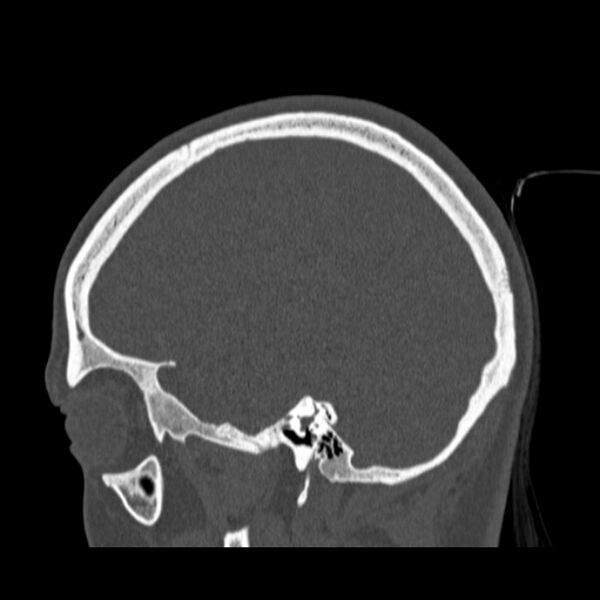 File:Calvarial osteoma (Radiopaedia 36520-38079 Sagittal bone window 79).jpg