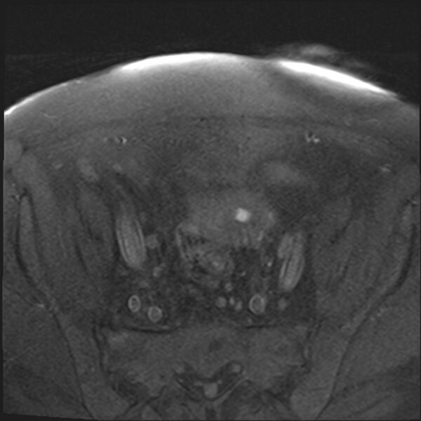 File:Cancer cervix - stage IIb (Radiopaedia 75411-86615 T1 fat sat 23).jpg