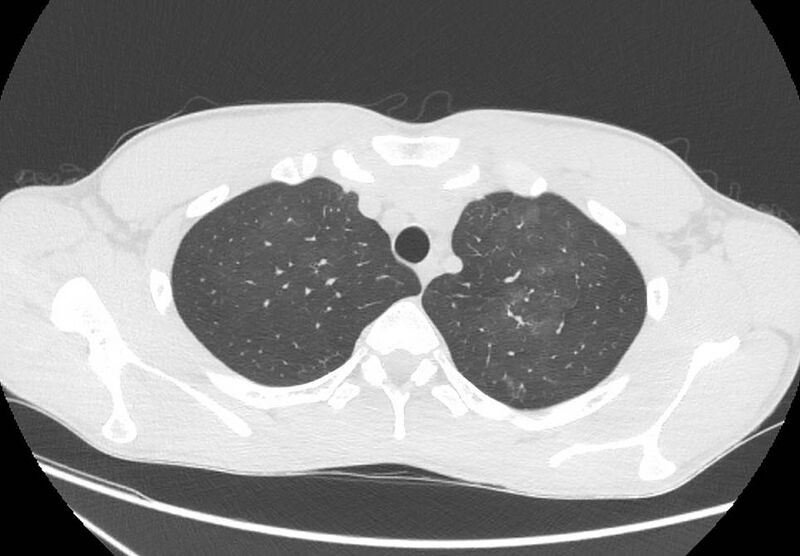 File:Cannabis-induced diffuse alveolar hemorrhage (Radiopaedia 89834-106946 Axial lung window 20).jpg