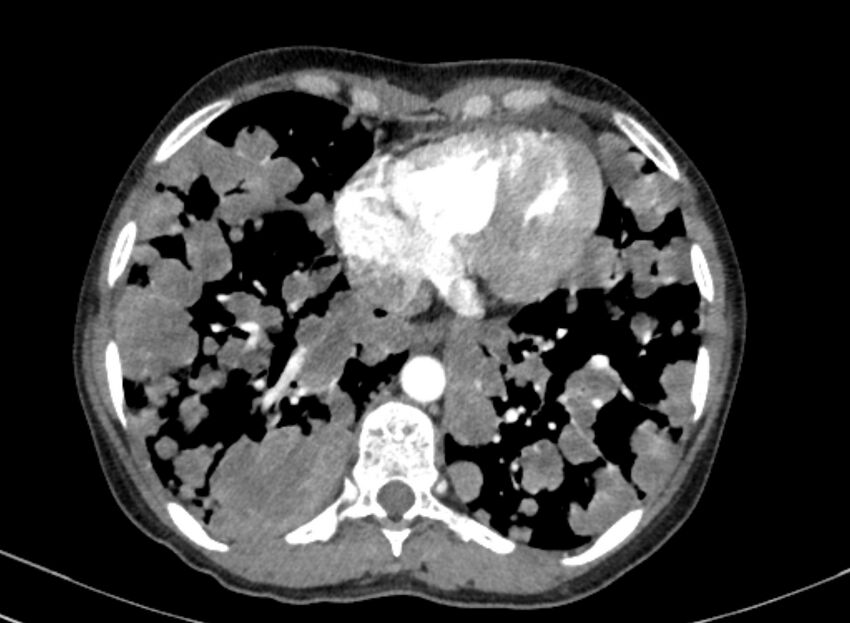 Cannonball metastases from breast cancer (Radiopaedia 91024-108569 A 88).jpg