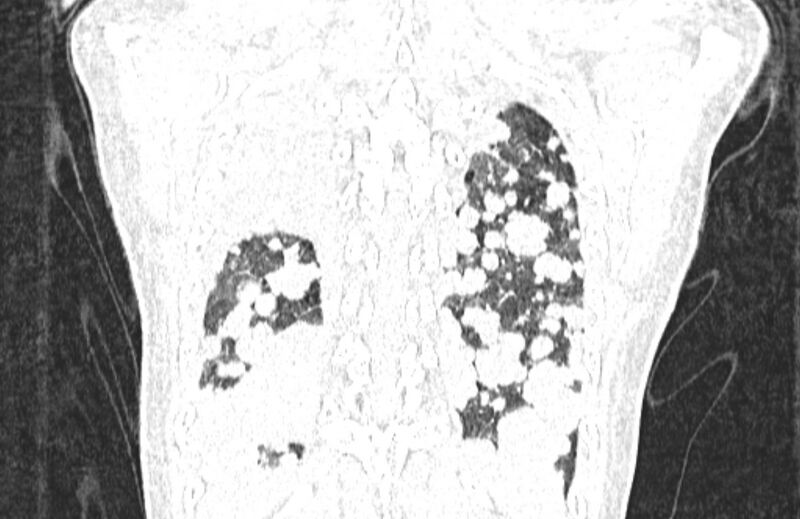File:Cannonball metastases from breast cancer (Radiopaedia 91024-108569 Coronal lung window 127).jpg