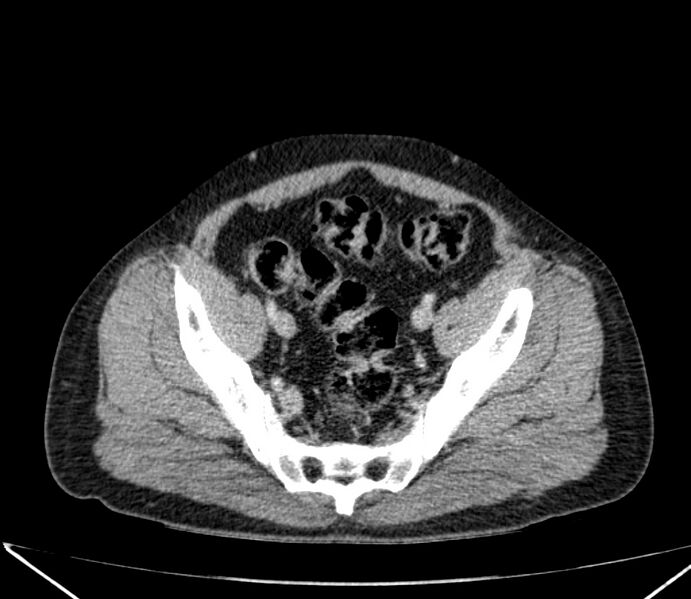 File:Carcinoid tumor with hepatic metastases (Radiopaedia 22651-22670 C 69).jpg