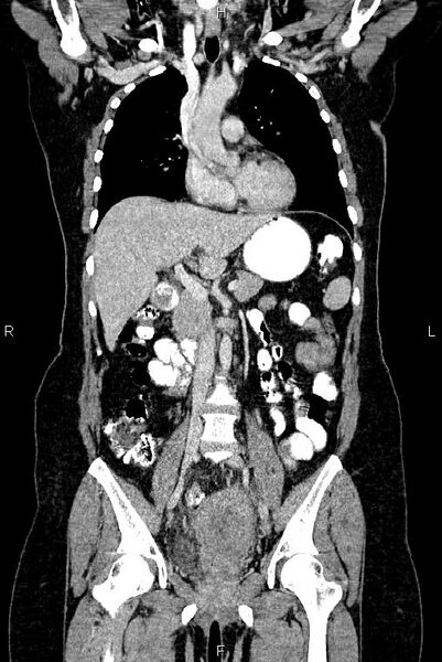 File:Carcinoma of uterine cervix (Radiopaedia 85861-101700 C 25).jpg
