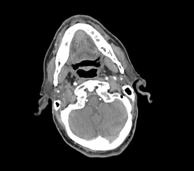 File:Carotid artery pseudoaneurysm (Radiopaedia 84030-99259 C 20).jpg