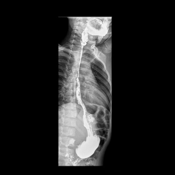 File:Caustic esophageal stricture (Radiopaedia 72422-82955 LAO projection 1).jpg