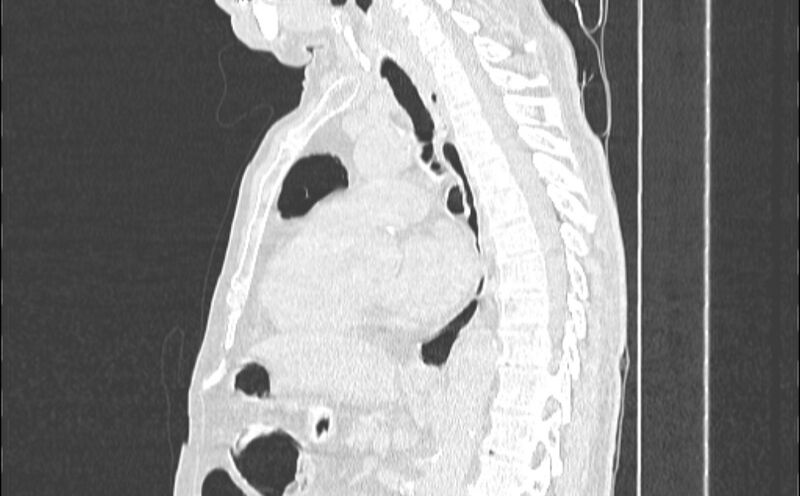 File:Cavitating bronchogenic carcinoma (Radiopaedia 44489-48162 Sagittal lung window 32).jpg