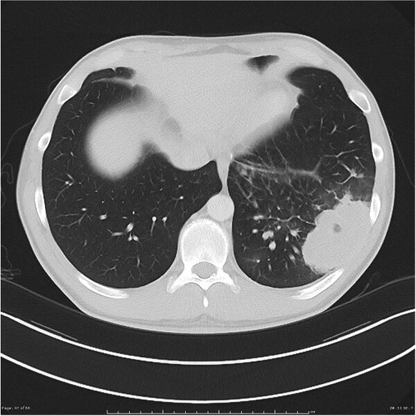 File:Cavitating lung cancer (Radiopaedia 25796-25945 Axial lung window 47).jpg