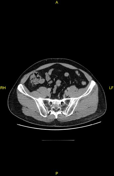 File:Cecal epiploic appendagitis (Radiopaedia 86047-102164 A 115).jpg