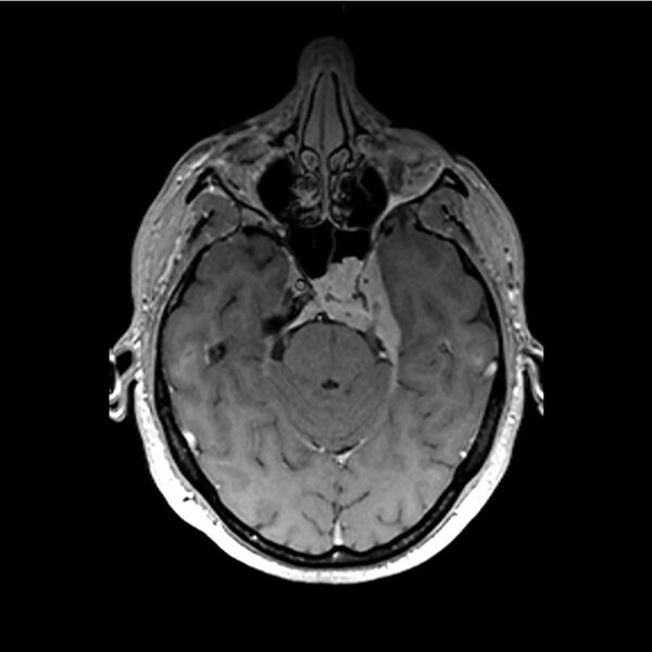 File:Central base of skull meningioma (Radiopaedia 53531-59549 Axial T1 C+ 13).jpg
