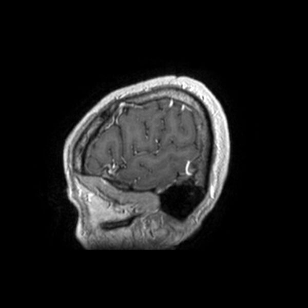 File:Central neurocytoma (Radiopaedia 67618-77021 Sagittal T1 C+ 26).jpg