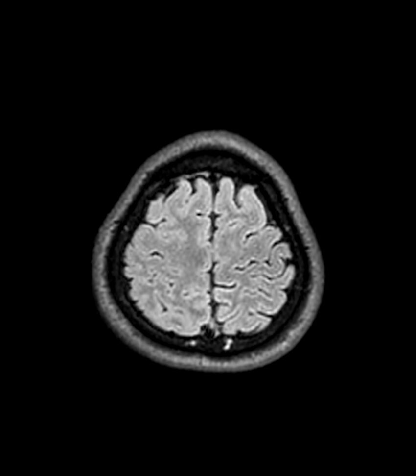 Central neurocytoma (Radiopaedia 79320-92380 Axial FLAIR 59).jpg