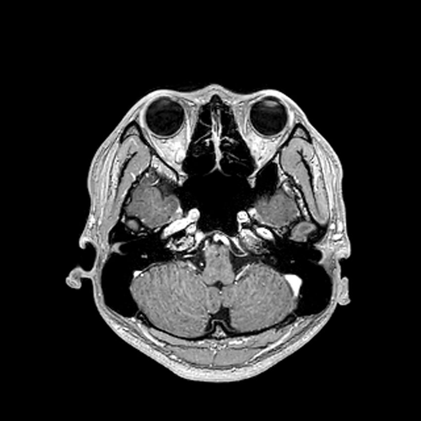 Central neurocytoma (Radiopaedia 79320-92380 Axial T1 C+ 69).jpg