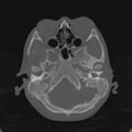 Cerebellar abscess secondary to mastoiditis (Radiopaedia 26284-26413 Axial bone window 36).jpg