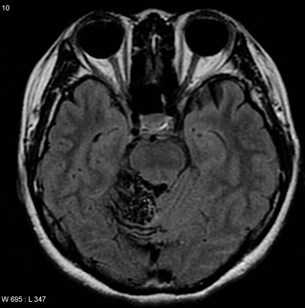 File:Cerebellar arteriovenous malformation (Radiopaedia 5220-6988 Axial FLAIR 1).jpg