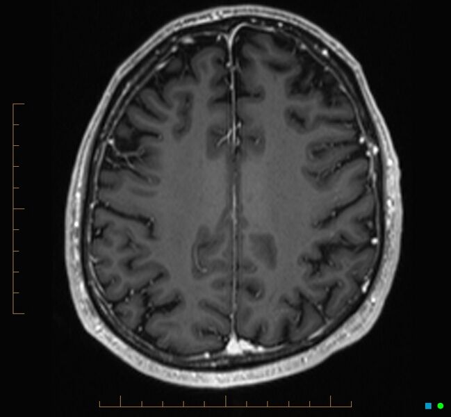 File:Cerebellar gangliocytoma (Radiopaedia 65377-74422 Axial T1 C+ 99).jpg