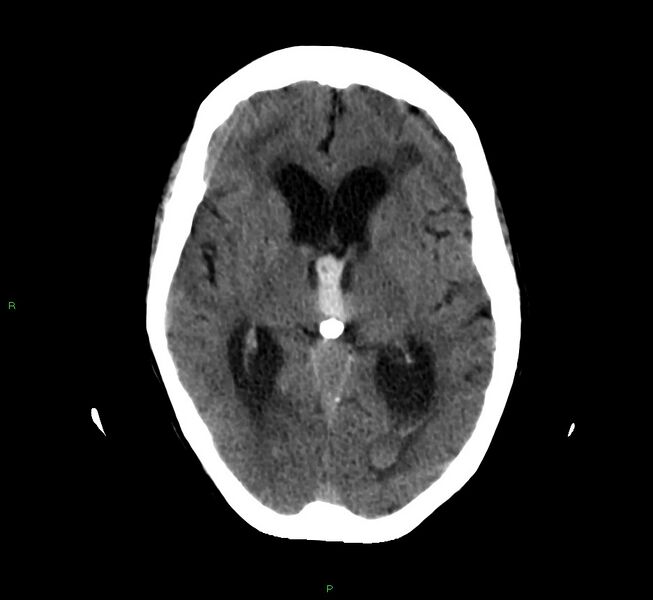 File:Cerebellar hemorrhage (Radiopaedia 58792-66026 Axial non-contrast 27).jpg