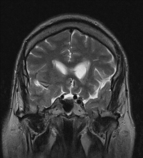 File:Cerebellopontine angle meningioma (Radiopaedia 24459-24764 Coronal T2 7).jpg