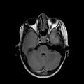 Cerebral abscess post cardiac surgery (Radiopaedia 27244-27420 Axial FLAIR 6).jpg