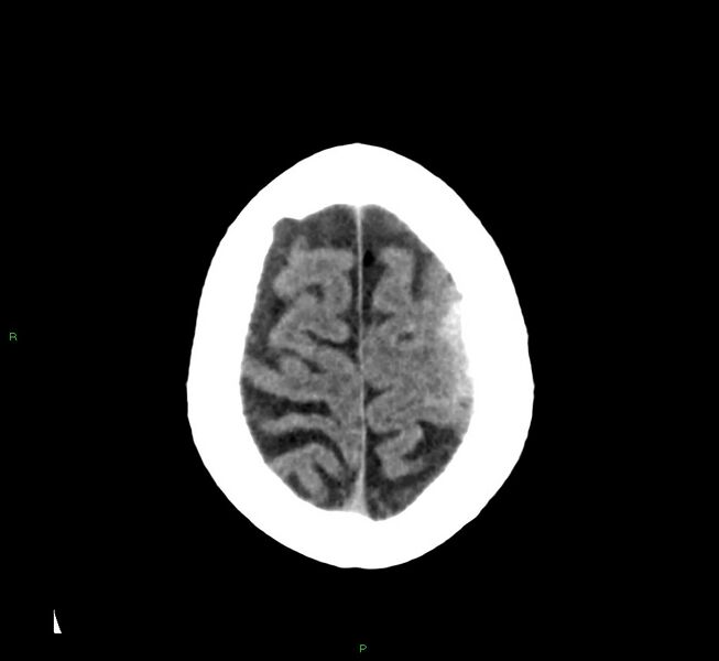 File:Cerebral amyloid angiopathy-associated lobar intracerebral hemorrhage (Radiopaedia 58376-65511 Axial non-contrast 11).jpg