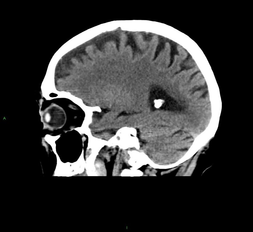 Cerebral amyloid angiopathy-associated lobar intracerebral hemorrhage (Radiopaedia 58376-65511 C 18).jpg