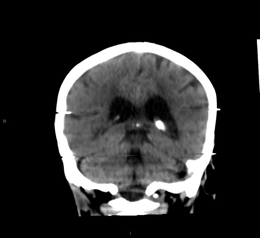 Cerebral amyloid angiopathy-associated lobar intracerebral hemorrhage (Radiopaedia 58377-65514 Coronal non-contrast 25).jpg