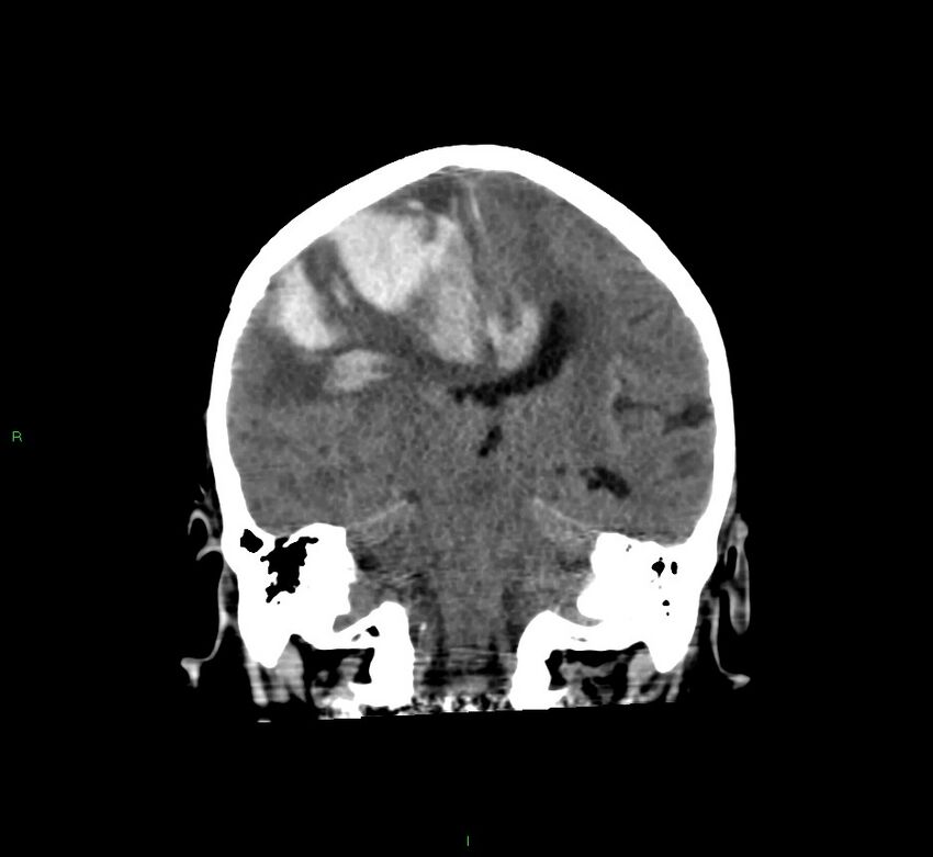Cerebral amyloid angiopathy-associated lobar intracerebral hemorrhage (Radiopaedia 58560-65723 Coronal non-contrast 33).jpg
