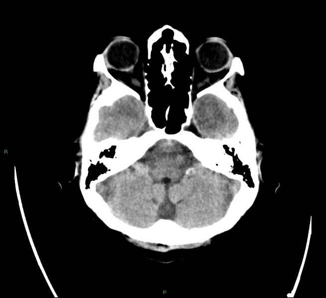 File:Cerebral amyloid angiopathy-associated lobar intracerebral hemorrhage (Radiopaedia 58566-65731 Axial non-contrast 5).jpg