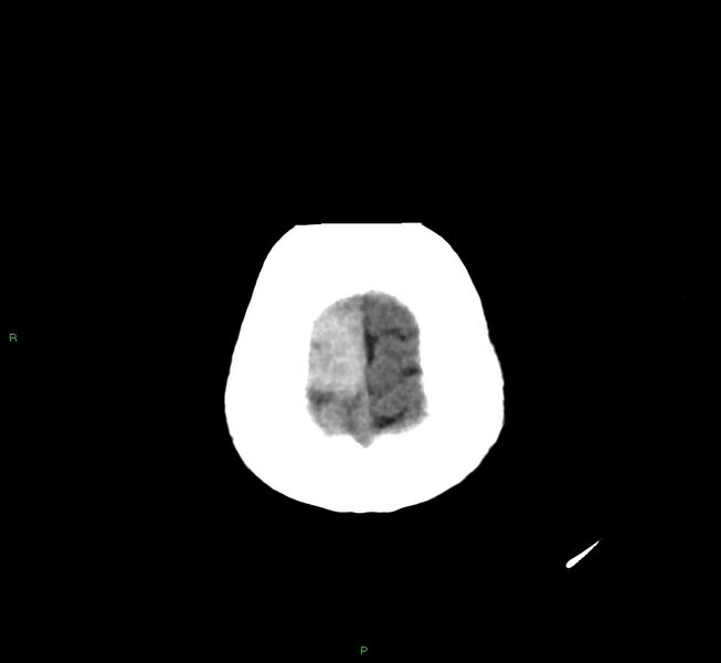 File:Cerebral amyloid angiopathy-associated lobar intracerebral hemorrhage (Radiopaedia 58751-65972 Axial non-contrast 5).jpg
