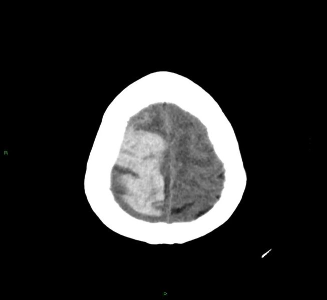 File:Cerebral amyloid angiopathy-associated lobar intracerebral hemorrhage (Radiopaedia 58751-65972 Axial non-contrast 9).jpg