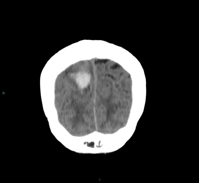 File:Cerebral amyloid angiopathy-associated lobar intracerebral hemorrhage (Radiopaedia 58751-65972 Coronal non-contrast 9).jpg