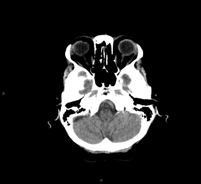 File:Cerebral amyloid angiopathy-associated lobar intracerebral hemorrhage (Radiopaedia 58757-65978 Axial non-contrast 41).jpg