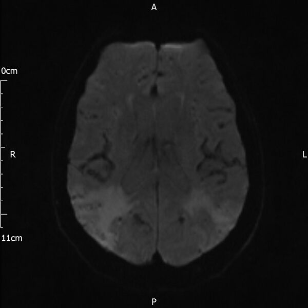 File:Cerebral amyloid angiopathy related inflammation (Radiopaedia 72772-83415 Axial DWI 37).jpg