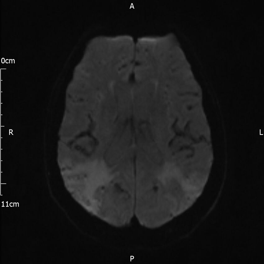 Cerebral amyloid angiopathy related inflammation (Radiopaedia 72772-83415 Axial DWI 37).jpg